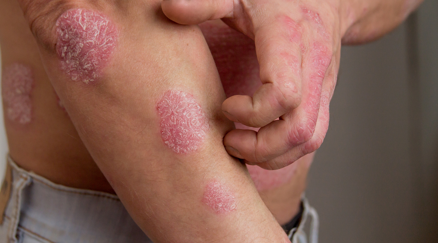 Living with Psoriasis? Treatments, Causes & Triggers