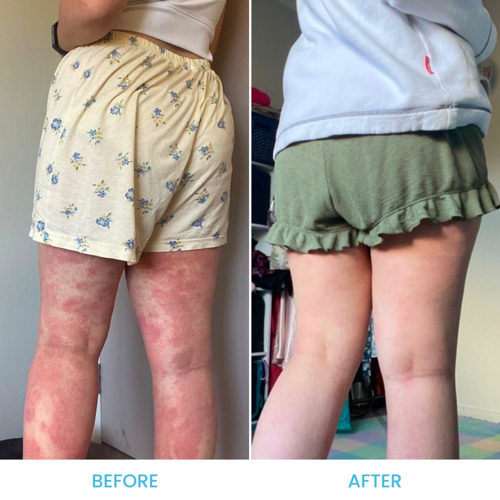 Eczema Pack *Limited Edition*