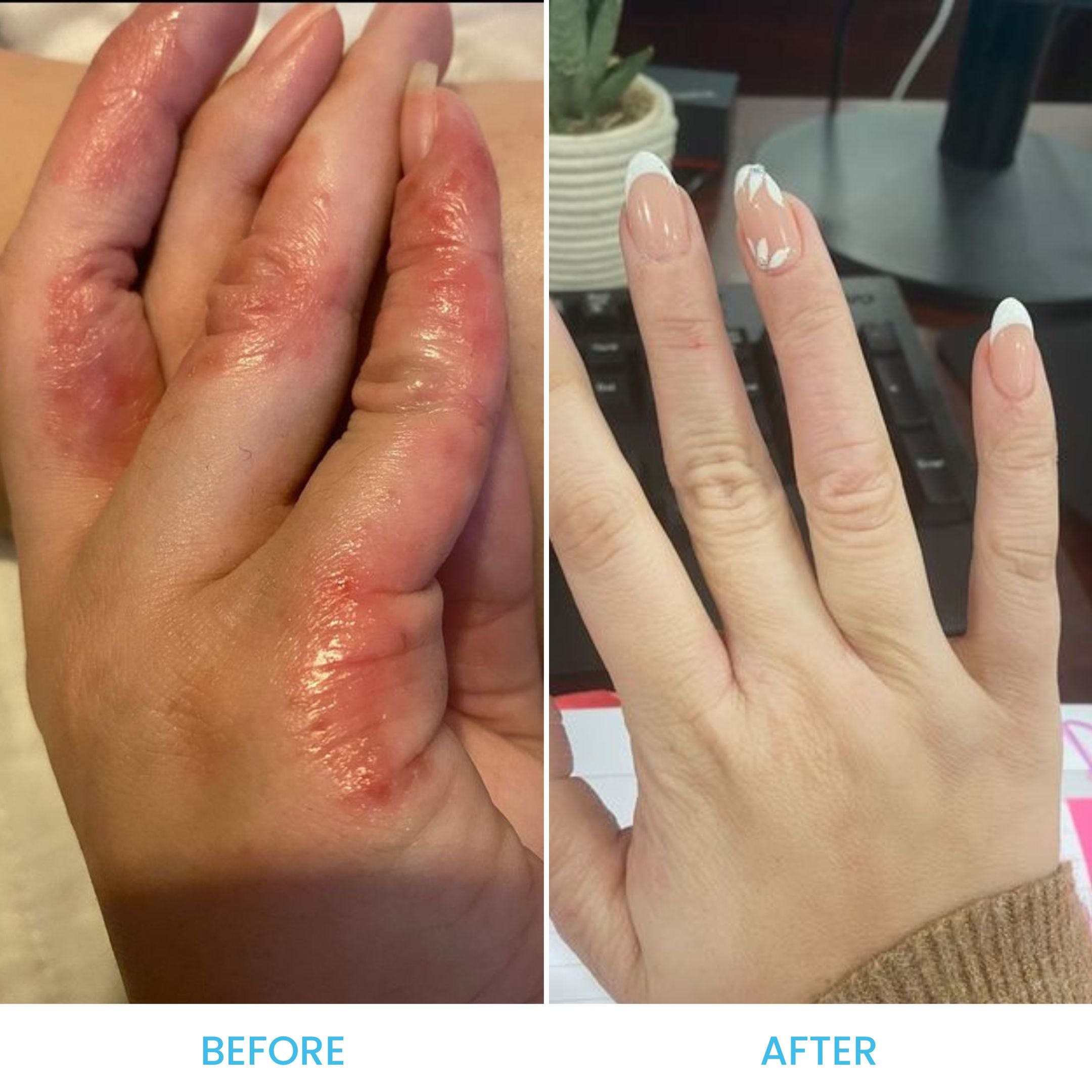 C+ Eczema & Dermatitis Cream