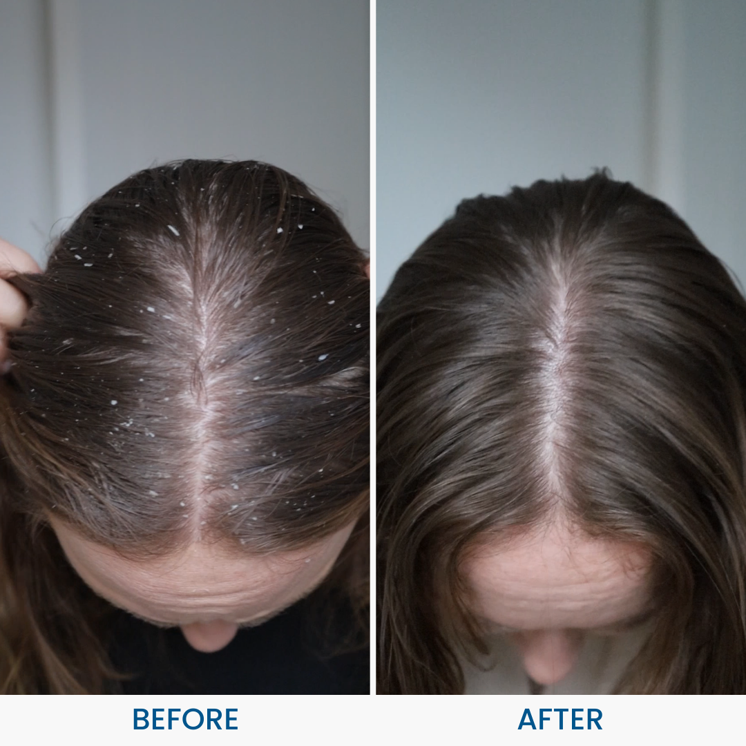 Grahams_Natural_Dandruff_Relief_Pack_Before_After_Results