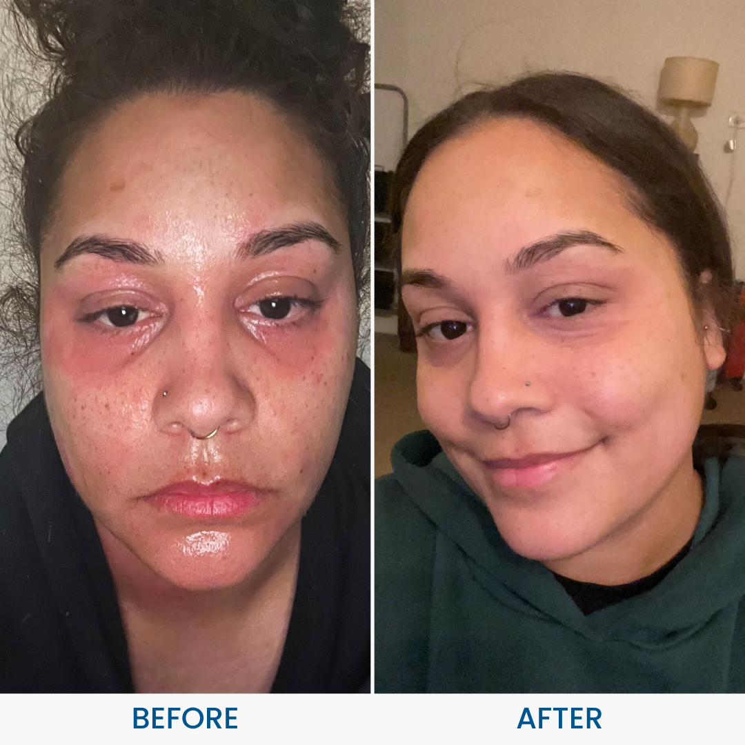 Grahams_Natural_Face_Eyelid_Eczema_Cream_Before_After_Results