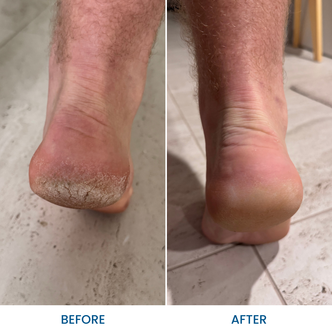 Grahams_Natural_Foot_Heel_Cream_Before_After_Results