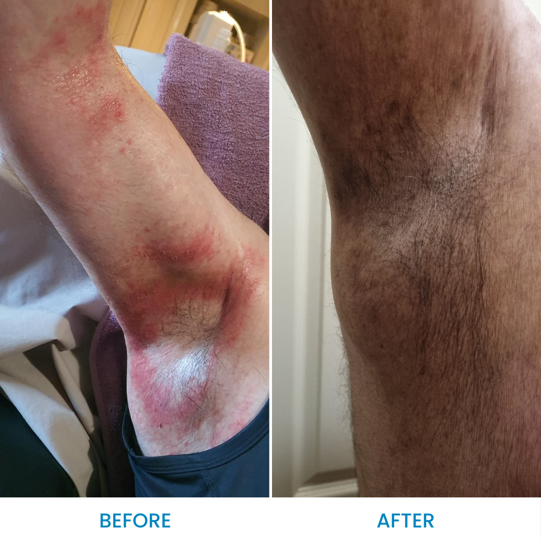 Grahams_Natural_Ultimate_Psoriasis_Pack_Before_After_Results
