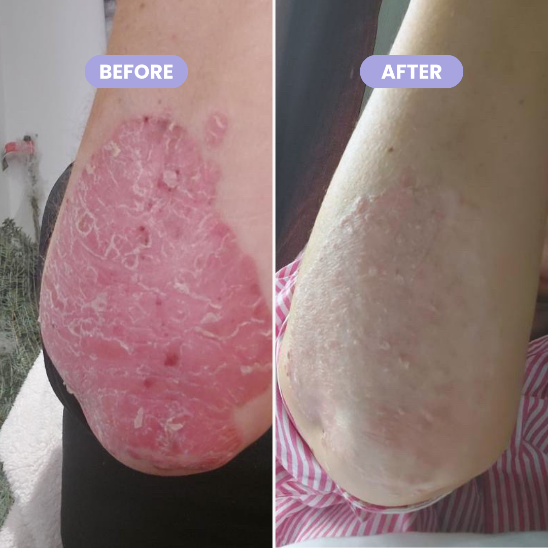 Inside Out Psoriasis Pack