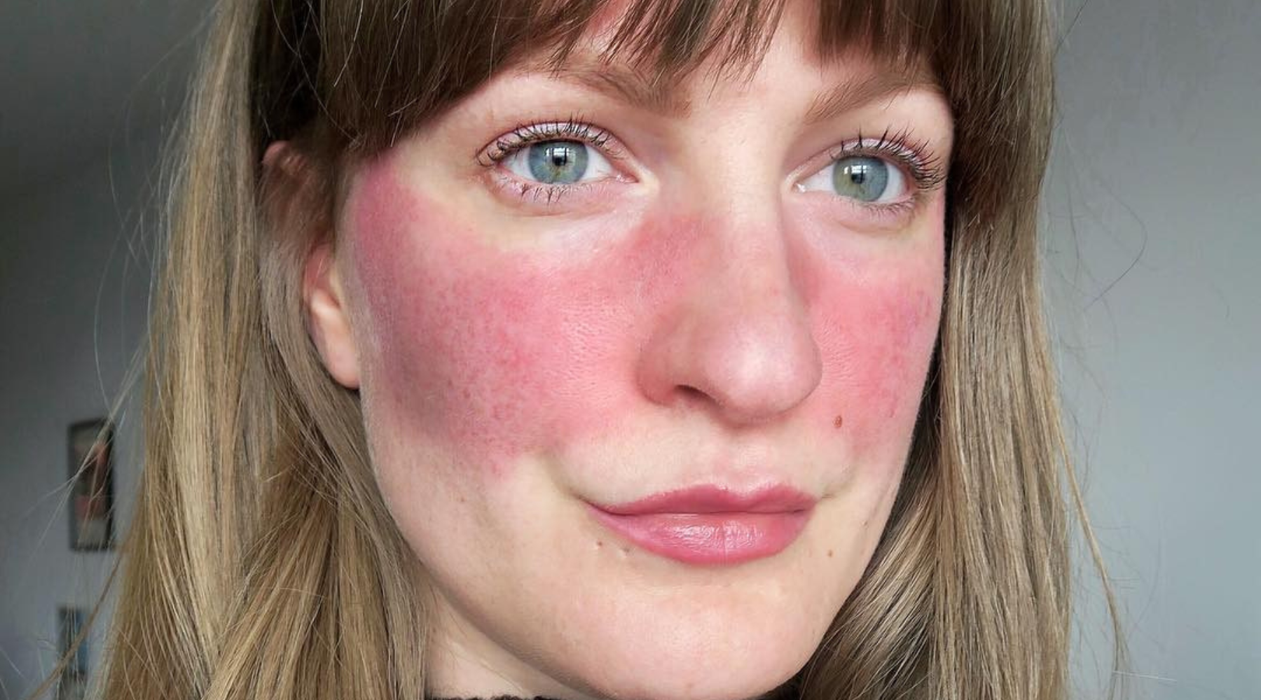 Young woman with visible rosacea on the cheeks and nose