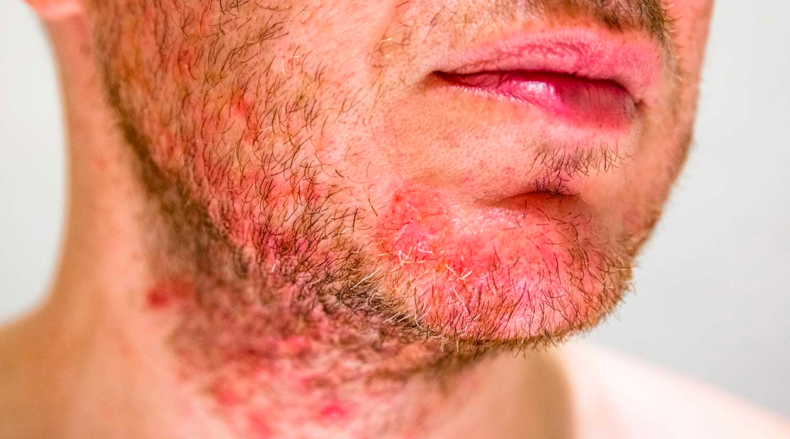 How to Treat Seborrheic Dermatitis on the Face