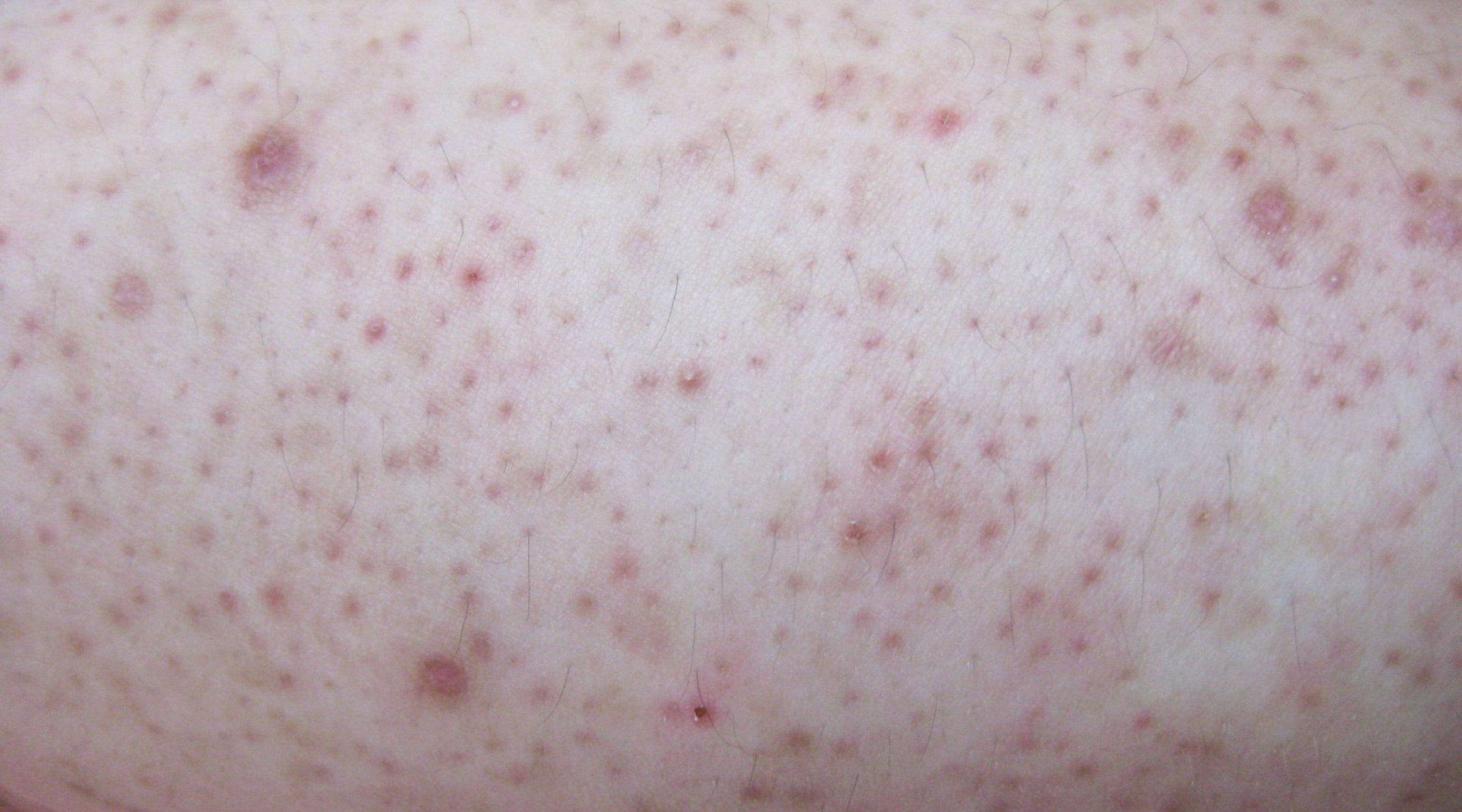 Keratosis Pilaris Causes Treatment Grahams Natural USA keratosis-pilaris-causes-treatment-grahams-natural-usa