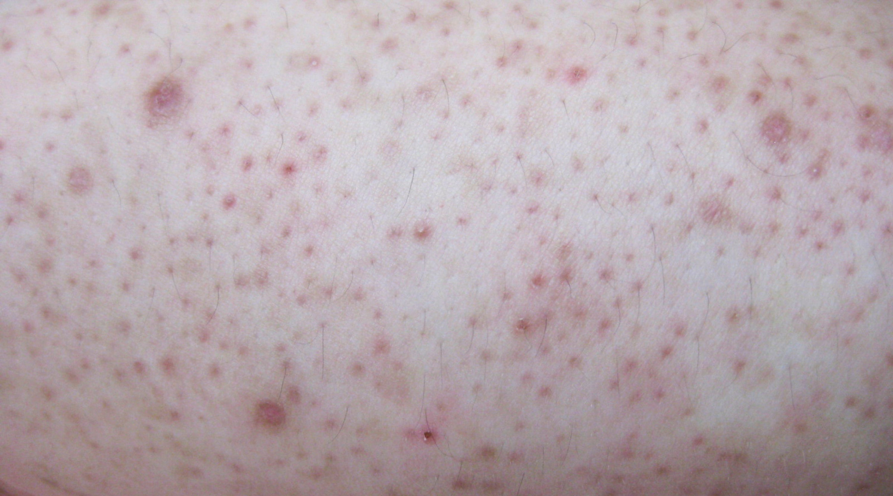 Keratosis Pilaris: Causes & Treatment