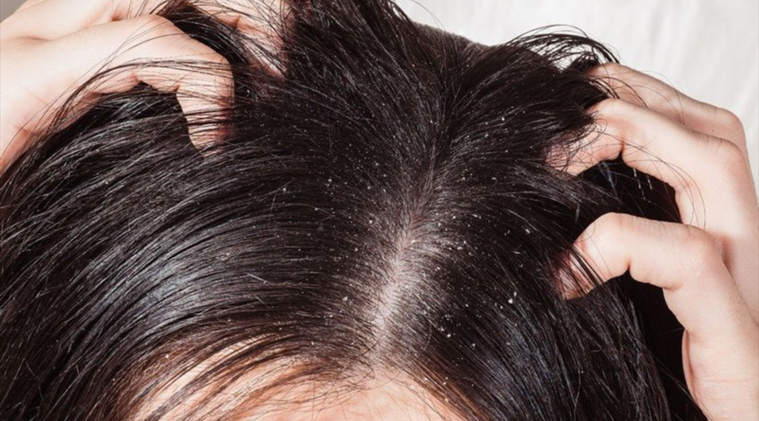 Do I Have Seborrheic Dermatitis or Dandruff?