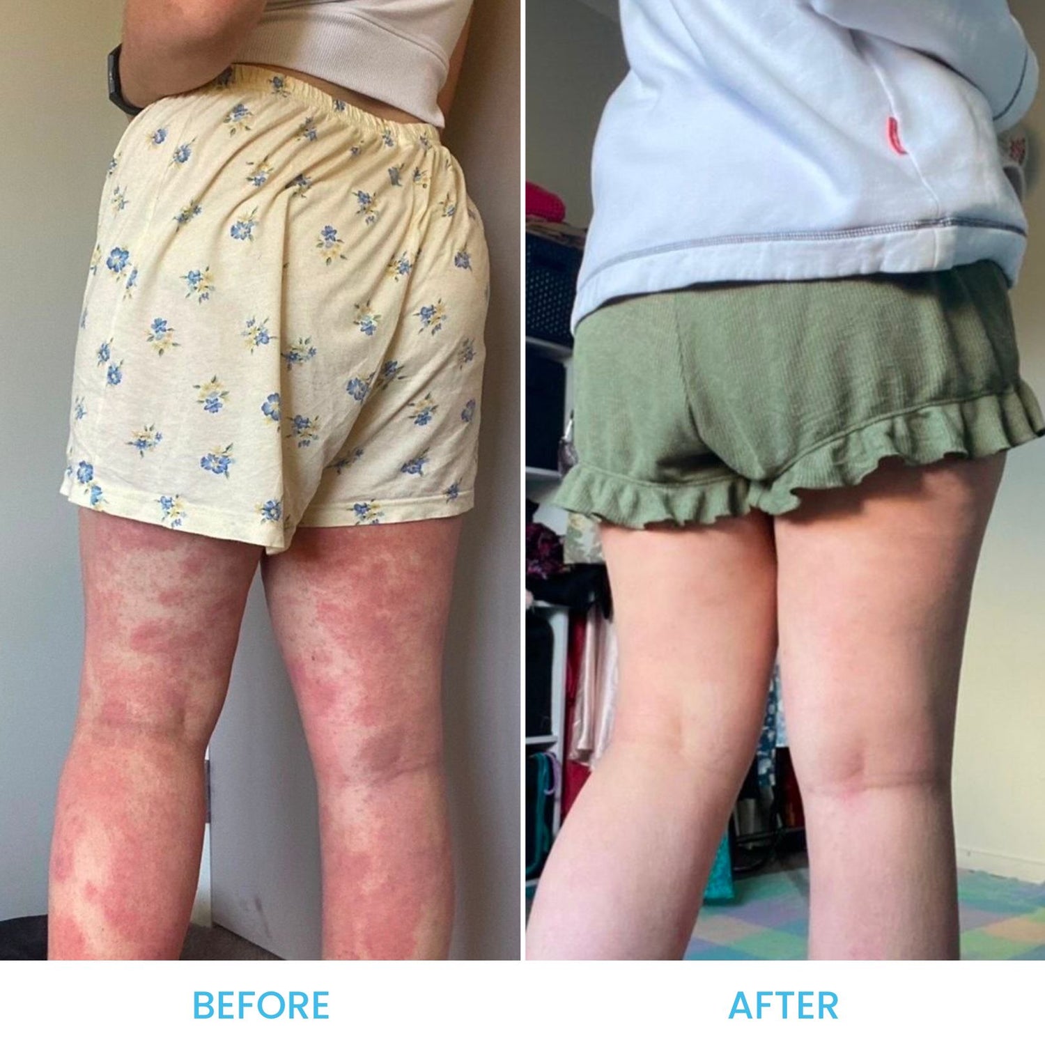 Eczema Pack *Limited Edition*