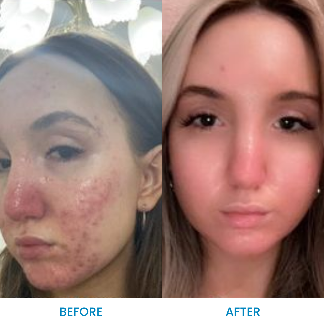 Rosacea Essentials Pack