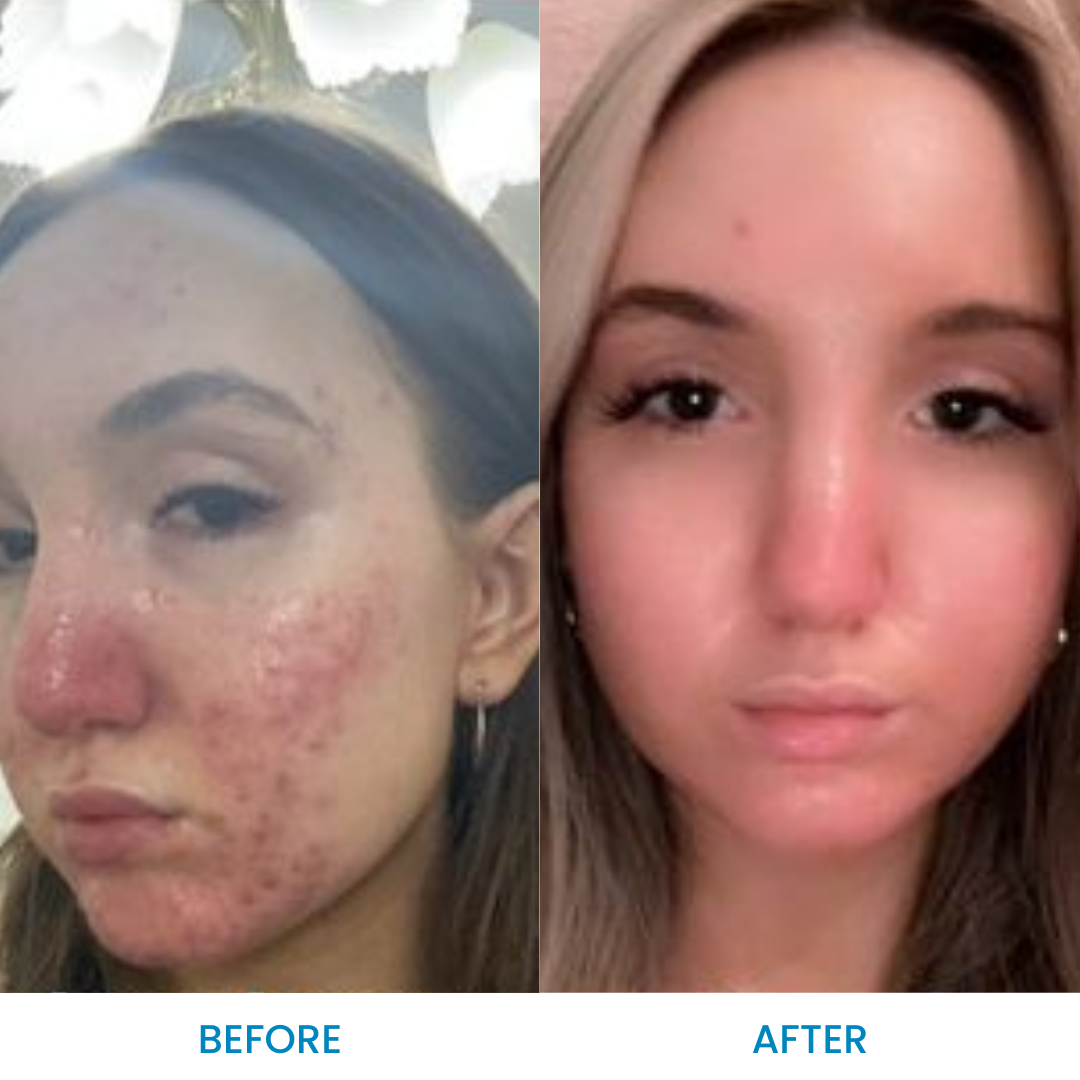 Rosacea Relief Pack