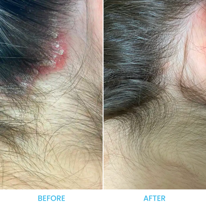 Scalp Psoriasis Pack