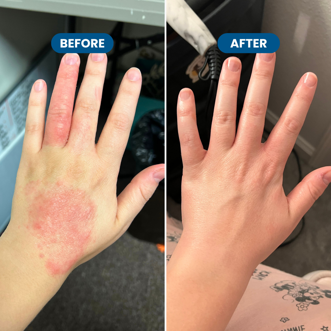 Inside Out Eczema Pack