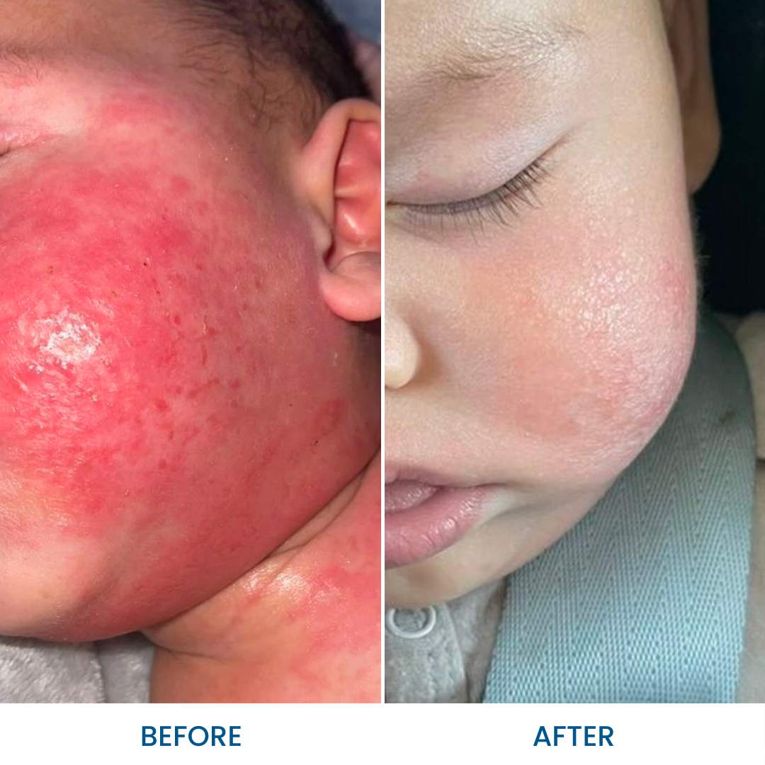 Grahams_Natural_Baby_Eczema_Pack_Before_After_Results