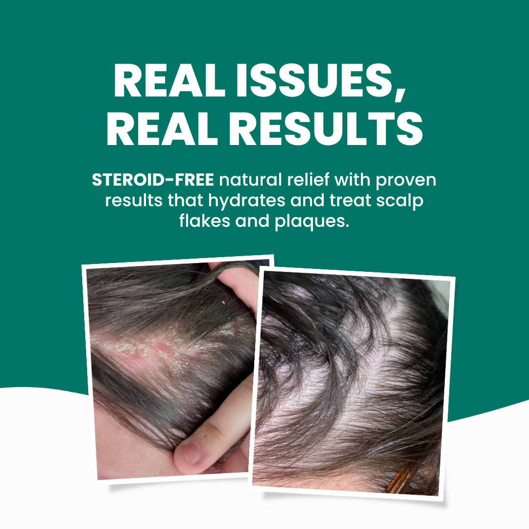 Grahams_Natural_Dandruff_Relief_Pack_Real_Results