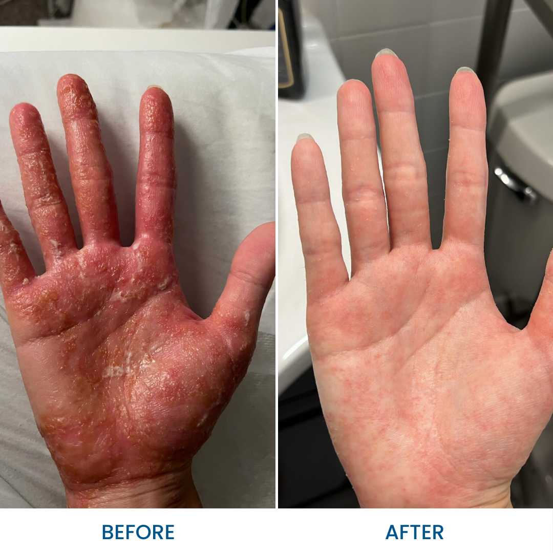 Grahams_Natural_Eczema_Flare_Pack_Before_After_Results
