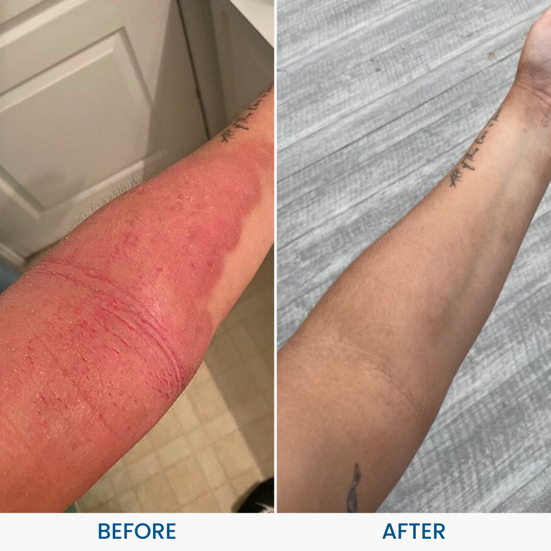 Grahams_Natural_Eczema_Trial_Pack_Before_After_Results