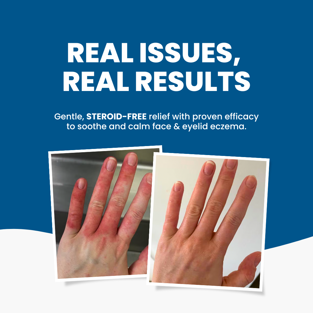 Grahams_Natural_Eczema_Trial_Pack_Real_Results