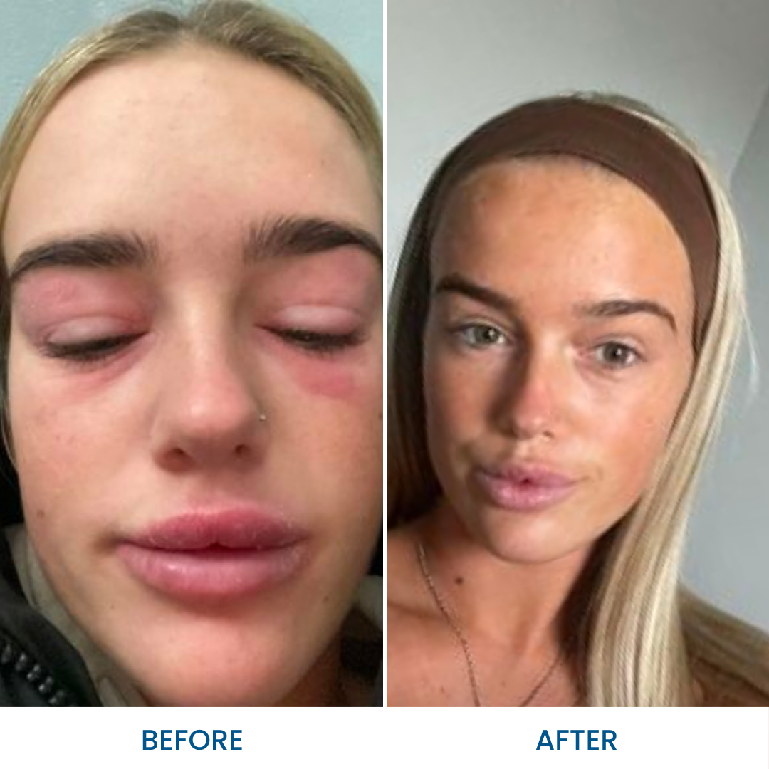 Grahams_Natural_Face_Eczema_Pack_Before_After_Results