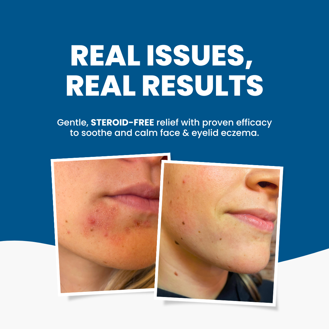 Grahams_Natural_Face_Eyelid_Eczema_Cream_Real_Results