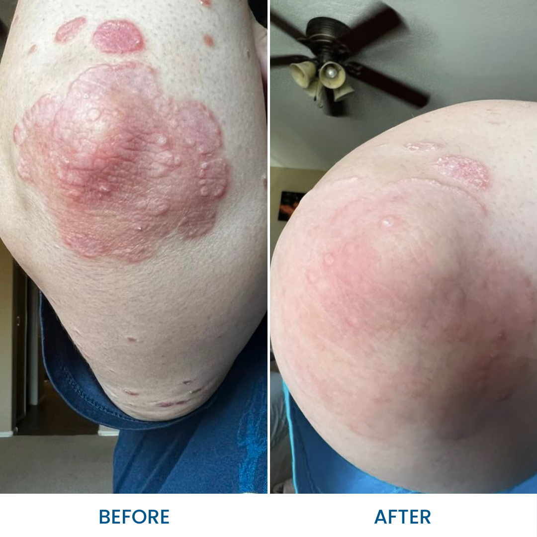 Grahams_Natural_Psoriasis_Therapeutic_Pack_Before_After_Results
