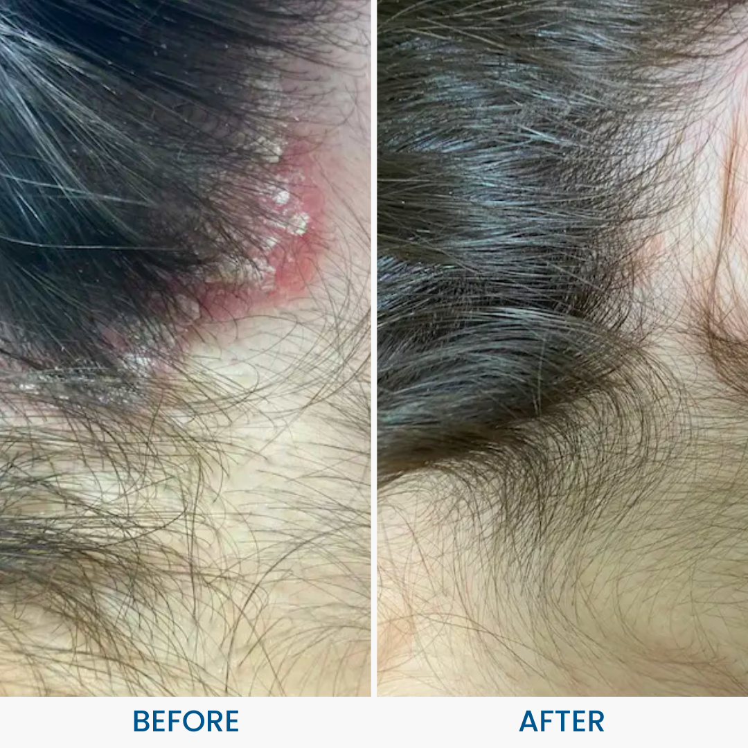 Grahams_Natural_Scalp_Psoriasis_Pack_Before_After_Results