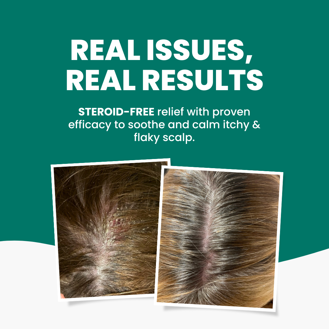Grahams_Natural_Scalp_Psoriasis_Pack_Real_Results