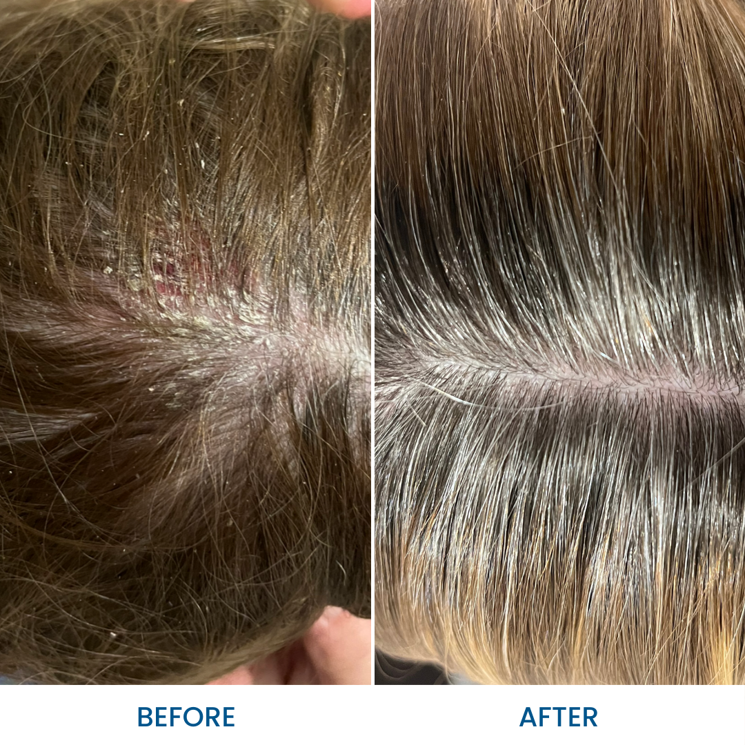 Grahams_Natural_Seborrheic_Dermatitis_Pack_Before_After_Results