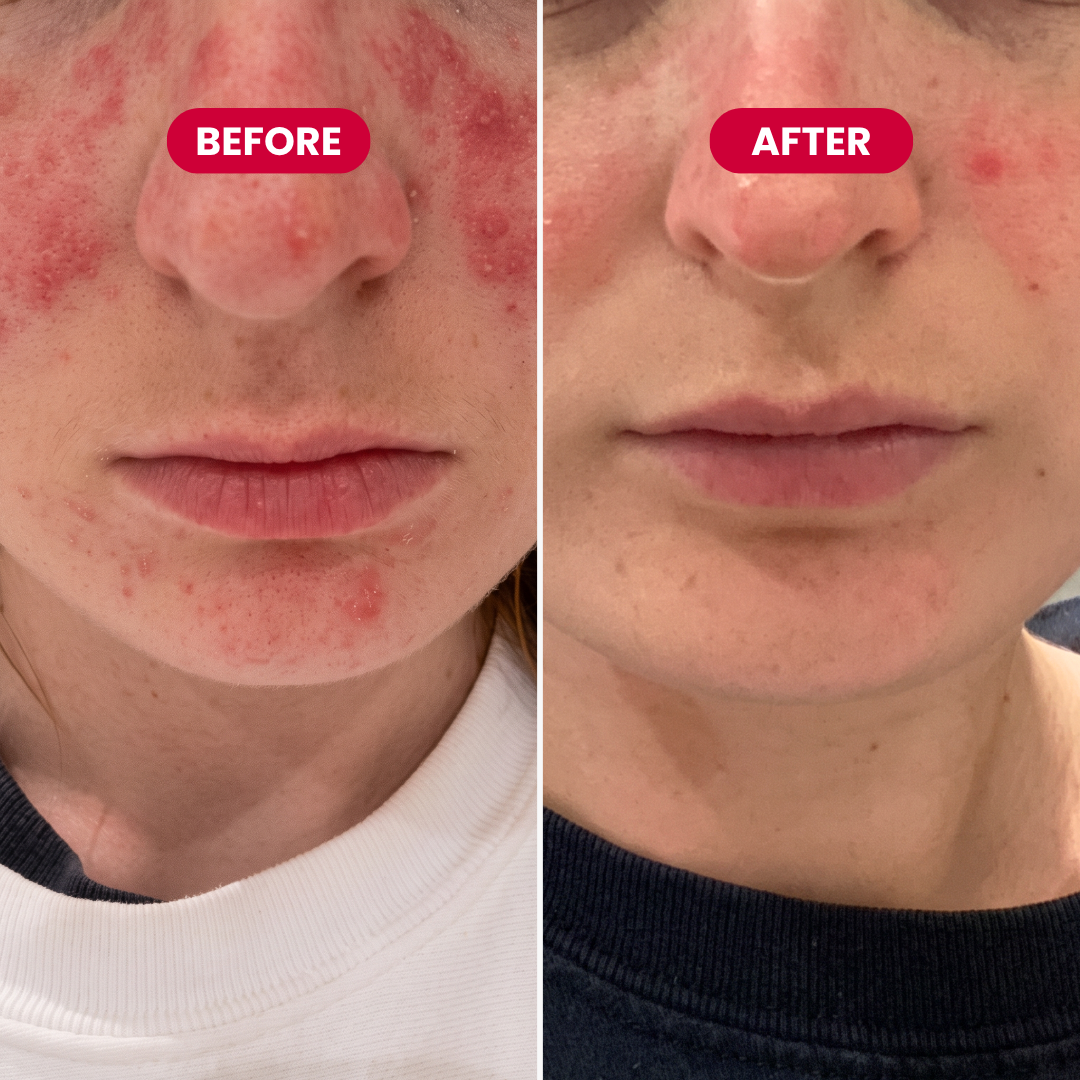 Inside Out Rosacea Pack