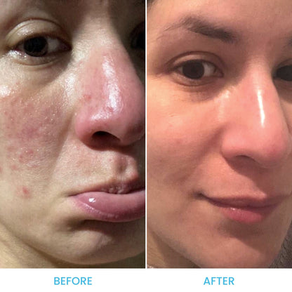 Rosacea Essentials Pack